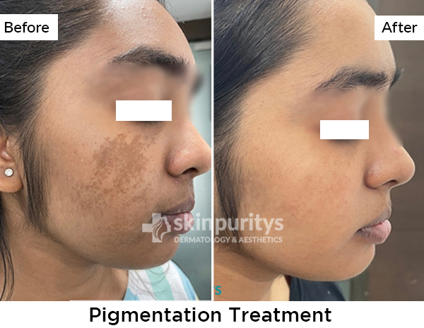 Pigmentation results